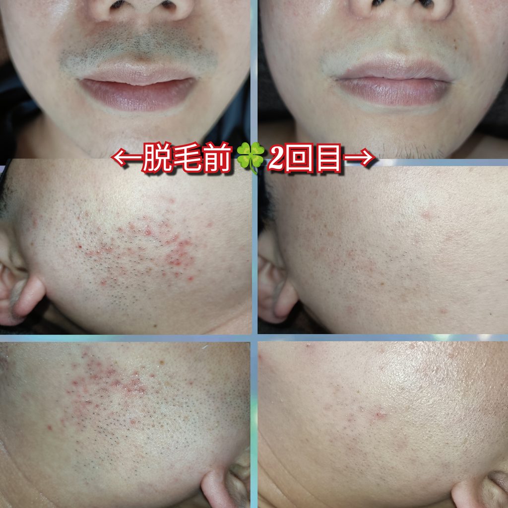 ヒゲ脱毛前と2回目の比較写真。ヒゲが目立ちにくくなり、カミソリ負けによる頬の赤みや肌荒れが減っている様子。大阪市住吉区のメンズ脱毛スポットQR。
